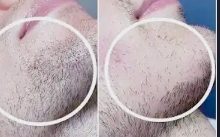 Before and after electrolysis hair removal results
