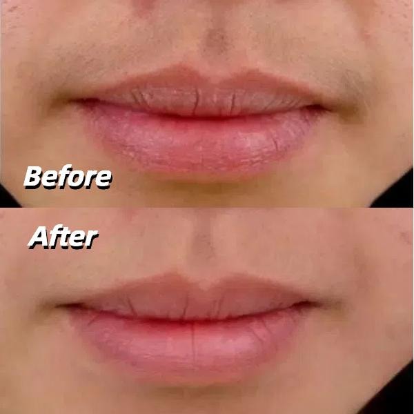 Before and after chin and upper lip hair removal