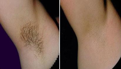 Before and after arm and underarm hair removal